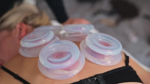 Cupping therapy is being performed on a person lying face down with several cups 스톡 동영상 344379332