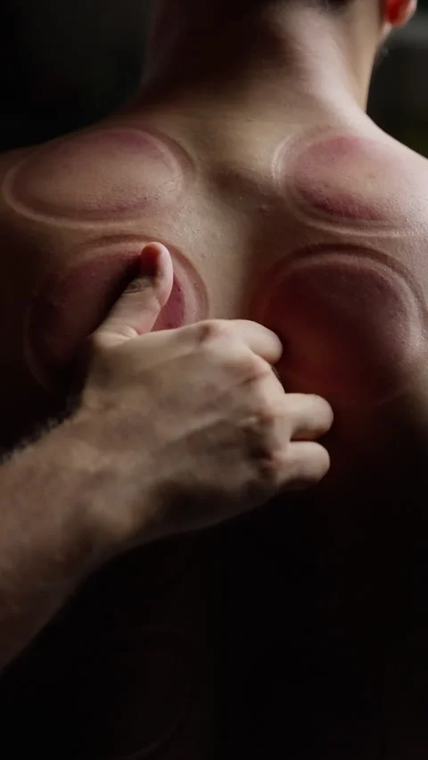 Cupping therapy demonstrating muscle relaxation technique, traditional healing Stock Footage 300363953