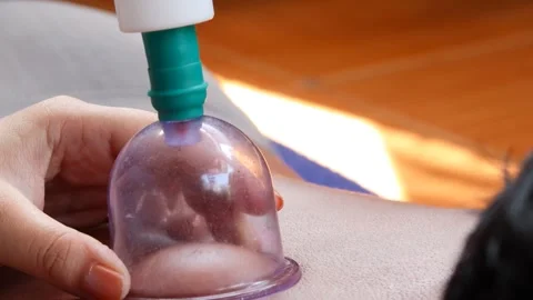 Cupping therapy on a man&amp;#039;s back using a suction cup device Stock Footage 344834553