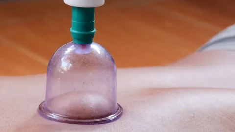Cupping therapy on a man&amp;#039;s back using a suction cup device Stock Footage 344834561