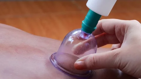 Cupping therapy on a man&amp;#039;s back using a suction cup device Stock Footage 344834564