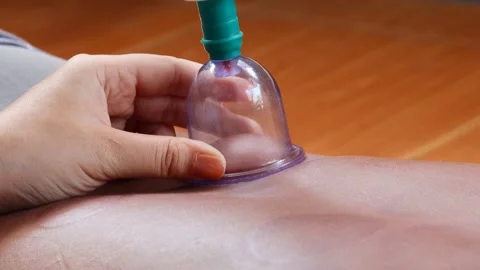 Cupping therapy on a man&amp;#039;s back using a suction cup device Stock Footage 344834594