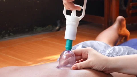 Cupping therapy on a man&amp;#039;s back using a suction cup device Stock Footage 344834607