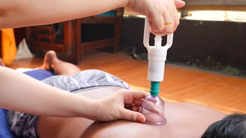 Cupping therapy on a man&amp;#039;s back using a suction cup device Stock Footage 344834609