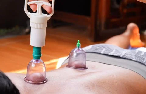 Cupping therapy on a man&amp;#039;s back using a suction cup device Stock Photos