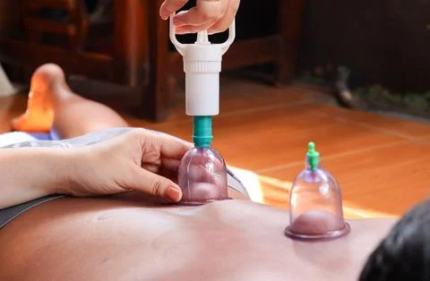 Cupping therapy on a man&amp;#039;s back using a suction cup device Stock Photos