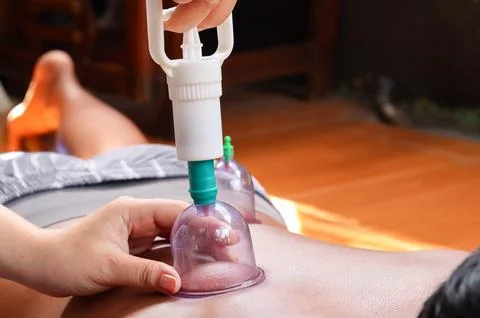 Cupping therapy on a man&amp;#039;s back using a suction cup device Stock Photos