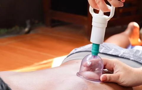 Cupping therapy on a man&amp;#039;s back using a suction cup device Stock Photos