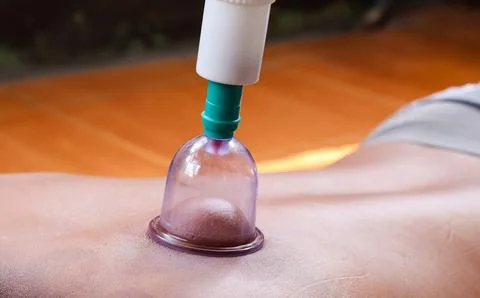 Cupping therapy on a man&amp;#039;s back using a suction cup device Stock Photos