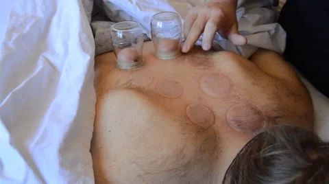 Cupping Therapy Is Now Over Stock Footage 47777945