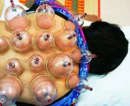 Cupping therapy Stock Photos