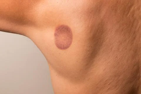 Cupping Therapy Stock Photos