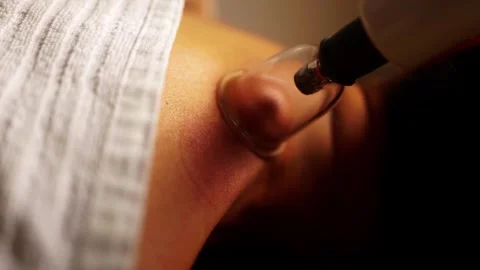 Cupping treatment on back - Alternative therapy massage for health, relaxation Stock Footage 316575004