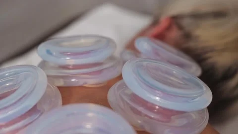 Cups are placed on the back of a person receiving treatment aimed at muscle Видео 344379174