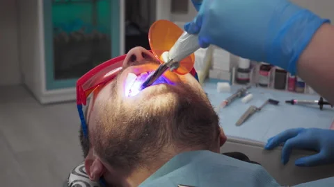 Curing Light Equipment Fixes Dental Filling Composite Material On Tooth Stock Footage 220045369