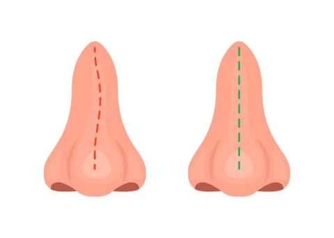 Curve and correct nose, correction nasal curvature, surgery rhinoplasty. Nose Stock Illustration
