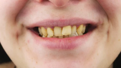 Curves yellow teeth close up. Stock-Footage 127589047