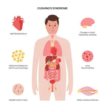 Cushing Desease poster Illustrazione stock