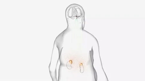 The Cushing Sendrom, Pituitary Adenoma Stock Footage 231402455
