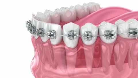 Cuspid correction with braces. Medically accurate dental 3D animation Stock Footage 237440814