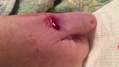 Cut Bleeding on Hand Video stock 99292332
