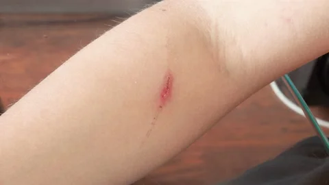 cut with blood on arm, Stock Video