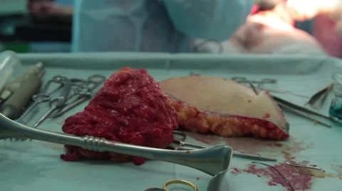 Cut during surgery chunks of human flesh Stock-Footage 67219996