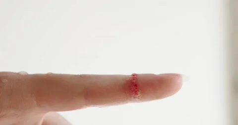 Cut on the finger Stock Footage 140236146