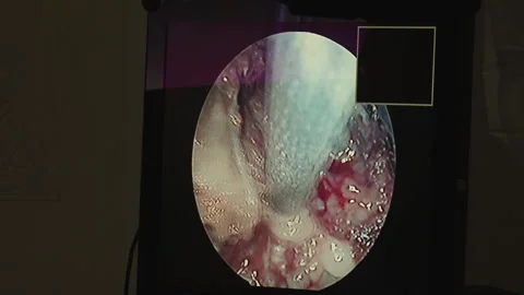 Cut out the hernia Stock Footage 130793746