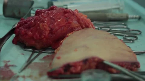 Cut pieces during the operation of the human stomach 스톡 동영상 67219830