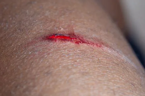 Cut in the skin 스톡 사진