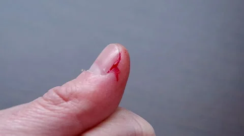 The cut thumb on the hand Stock Footage 37316895