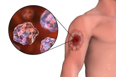 Cutaneous leishmaniasis ulcer and close-up view of Leishmania amastigotes Illustrazione stock