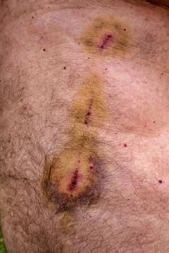 Cuts and bruises. 写真素材