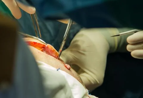 Cutting of the scalp. Stock Photos