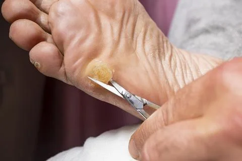 Cutting a sole callus with a silver scissors, soft focus close up Stock Photos