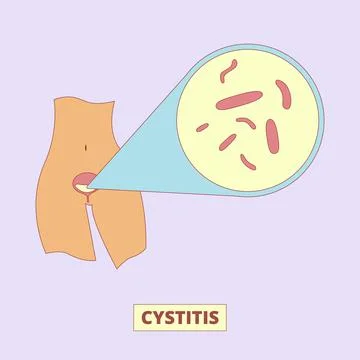 Cystitis, bacterial infection of urinary bladder illustration Illustrazione stock