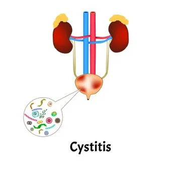 Cystitis. Inflammation of the bladder. The structure of the kidneys and bladder Stock Illustration
