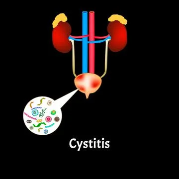 Cystitis. Inflammation of the bladder. The structure of the kidneys and bladder Stock Illustration