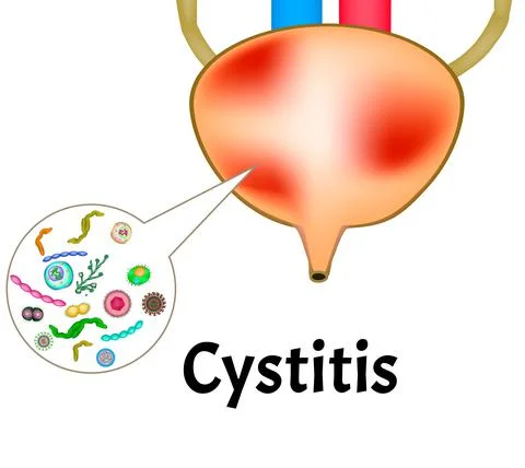 Cystitis. Inflammation of the bladder. The structure of the kidneys and bladder Illustrazione stock