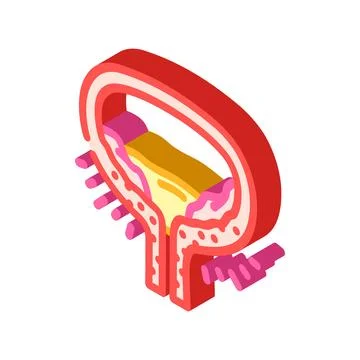 Cystitis urology isometric icon vector illustration Stock Illustration