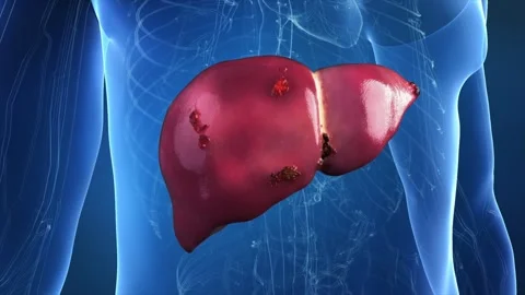 Cysts spread throughout the liver, turning a healthy organ 스톡 동영상 344102629