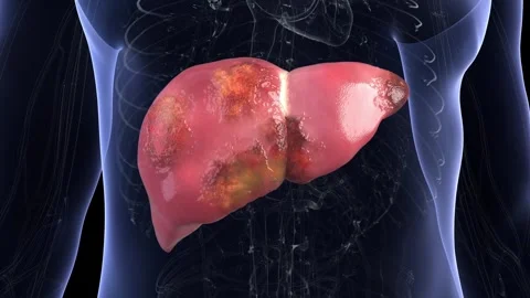 Cysts spread throughout the liver, turning a healthy organ Stockbeeldmateriaal 344102634