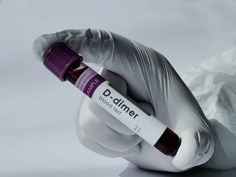 D-dimer blood test Stock Photos