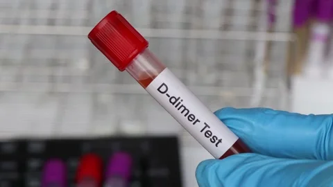 D-dimer test to look for abnormalities f... | Stock Video | Pond5