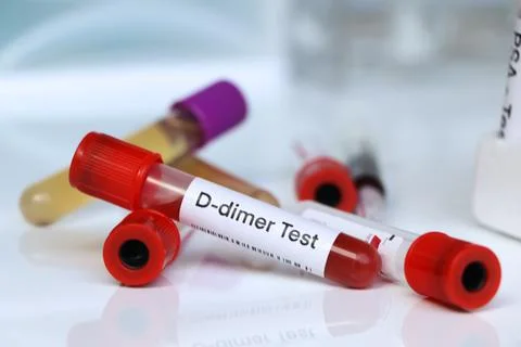 D-dimer test to look for abnormalities from blood 스톡 사진