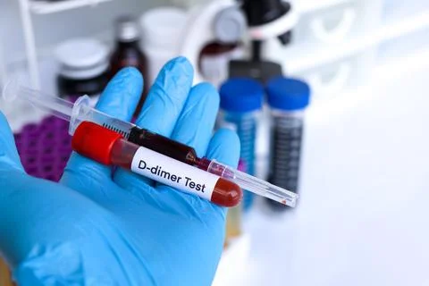 D-dimer test to look for abnormalities from blood 스톡 사진