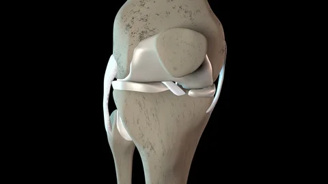 Damage To The Knee Cartilage Stock Footage 122447160
