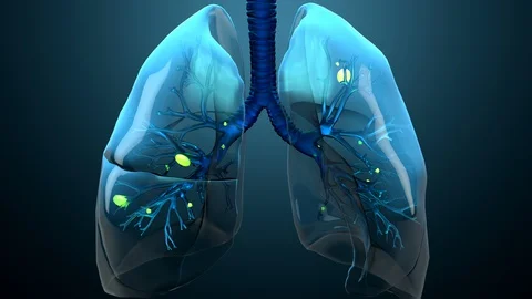 Damage lungs, severe respiratory illness, pneumonia, ARDS, acute respiratory dis Stock Footage