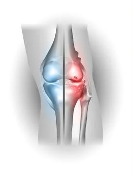 Damaged and healthy joint design Stock Illustration